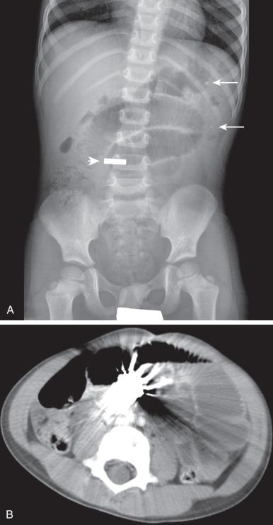 Figure 104.2, Foreign body ingestion from a magnet causing small bowel obstruction.