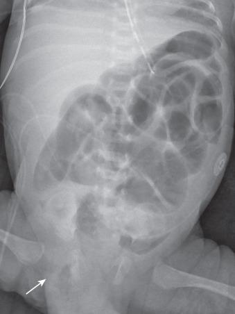 Figure 104.3, Small bowel obstruction caused by inguinal hernia.