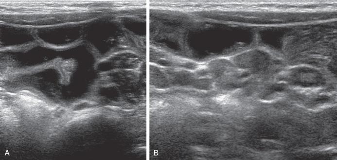 e-Figure 104.4, Gastroenteritis.