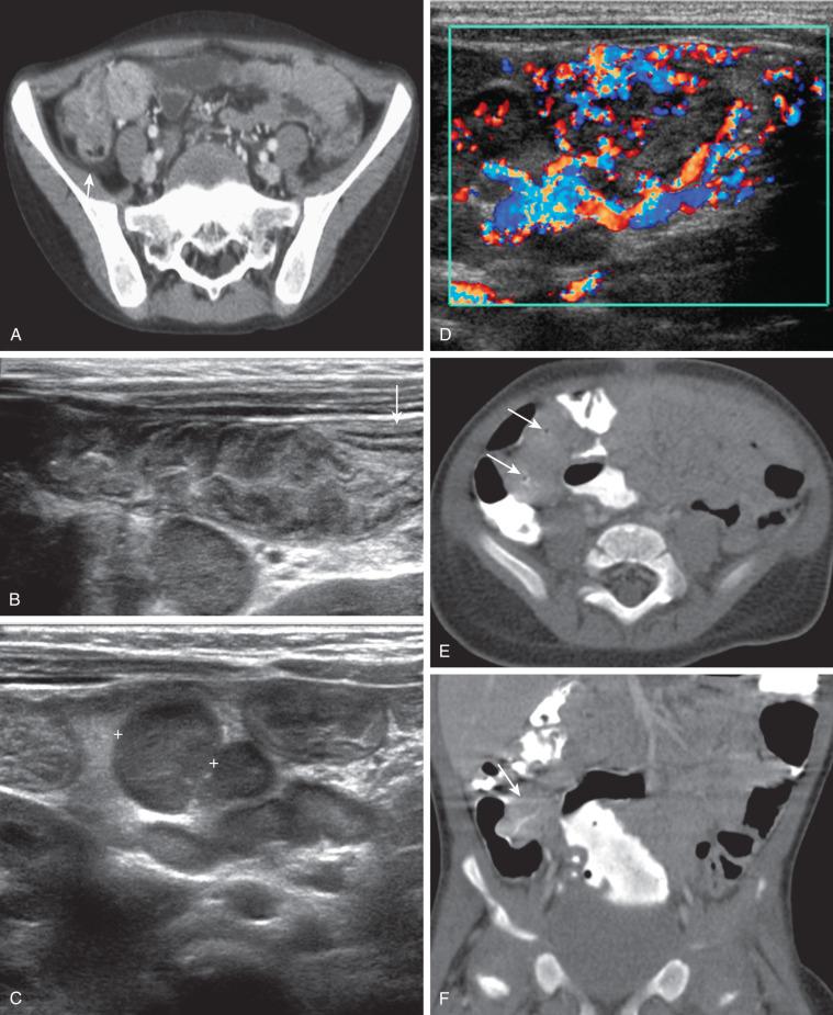 Figure 104.5, Bacterial enterocolitis.