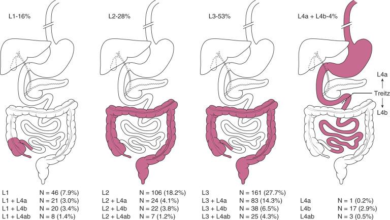 Figure 104.6, Disease location according to the Paris classification in 582 newly diagnosed pediatric CD patients who underwent a complete diagnostic workup according to the Porto criteria.