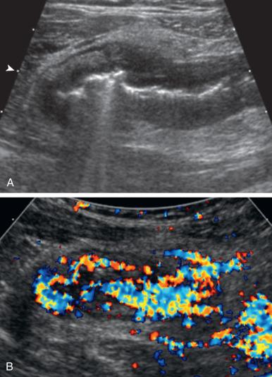 Figure 104.8, Crohn disease.