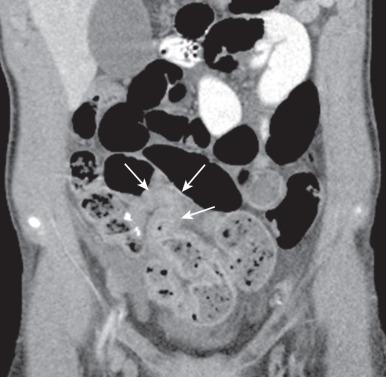 Figure 104.9, Crohn disease stricture.