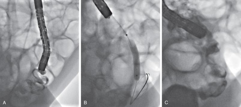 e-Figure 104.10, Crohn disease stricture.