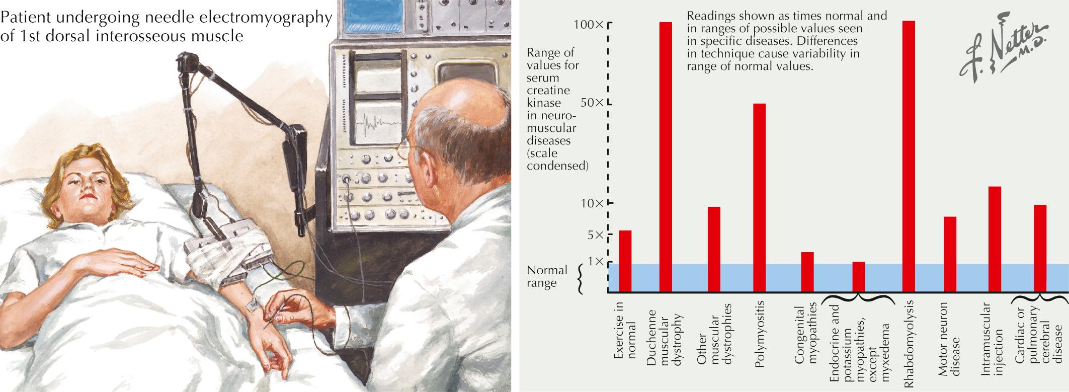 Fig. 71.2, Laboratory Studies in Neuromuscular Diseases: Electromyography and Serum Enzymes.