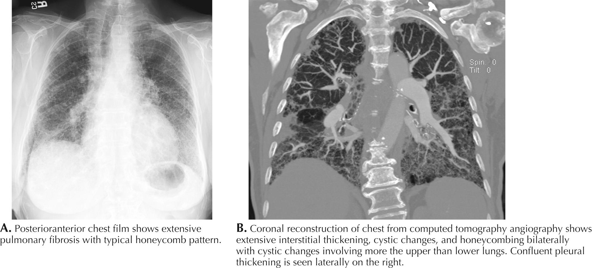 Fig. 71.3, Severe Pulmonary Fibrosis.