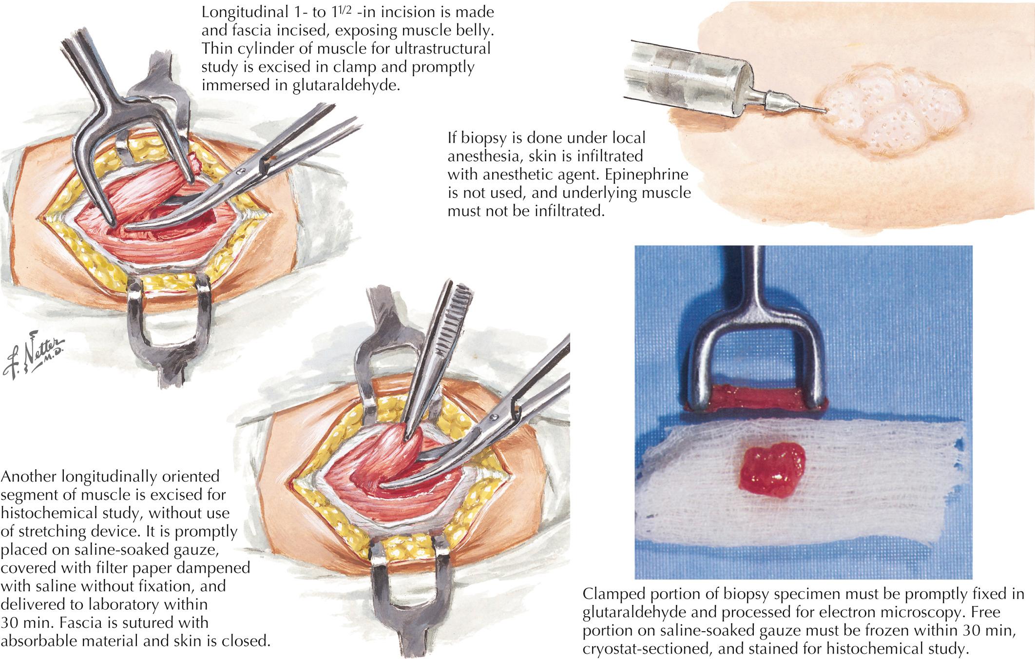 Fig. 71.5, Muscle Biopsy: Technique.