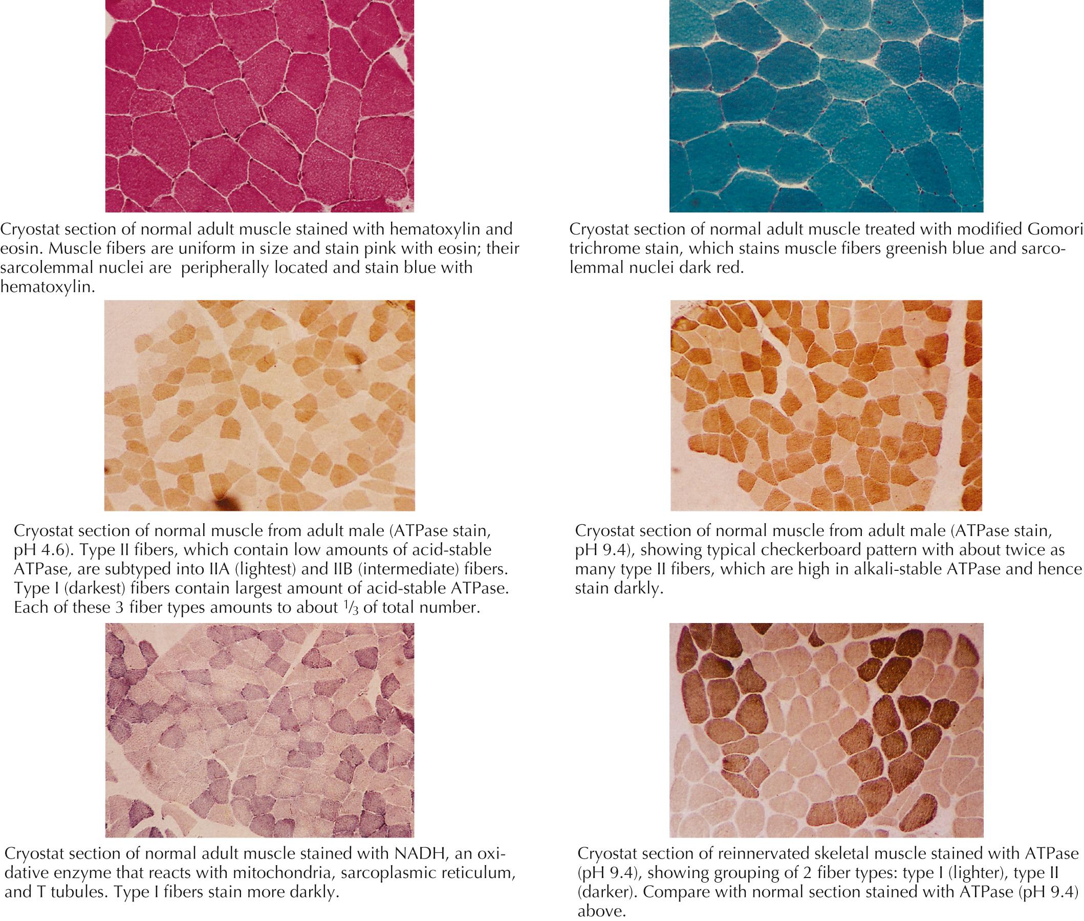 Fig. 71.6, Sections From Muscle Biopsy Specimens.