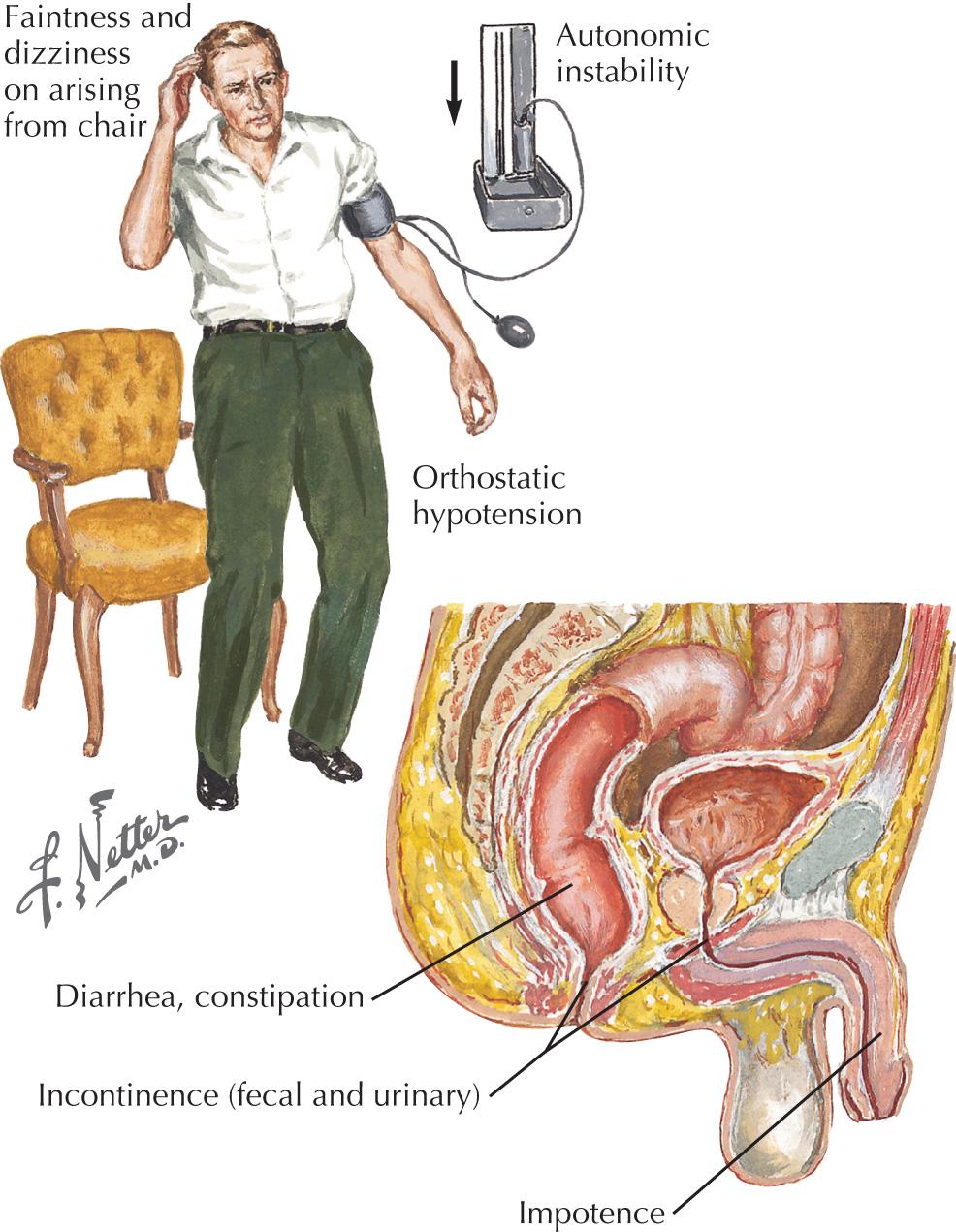 Fig. 67.1, Dysautonomia With Polyneuropathies.