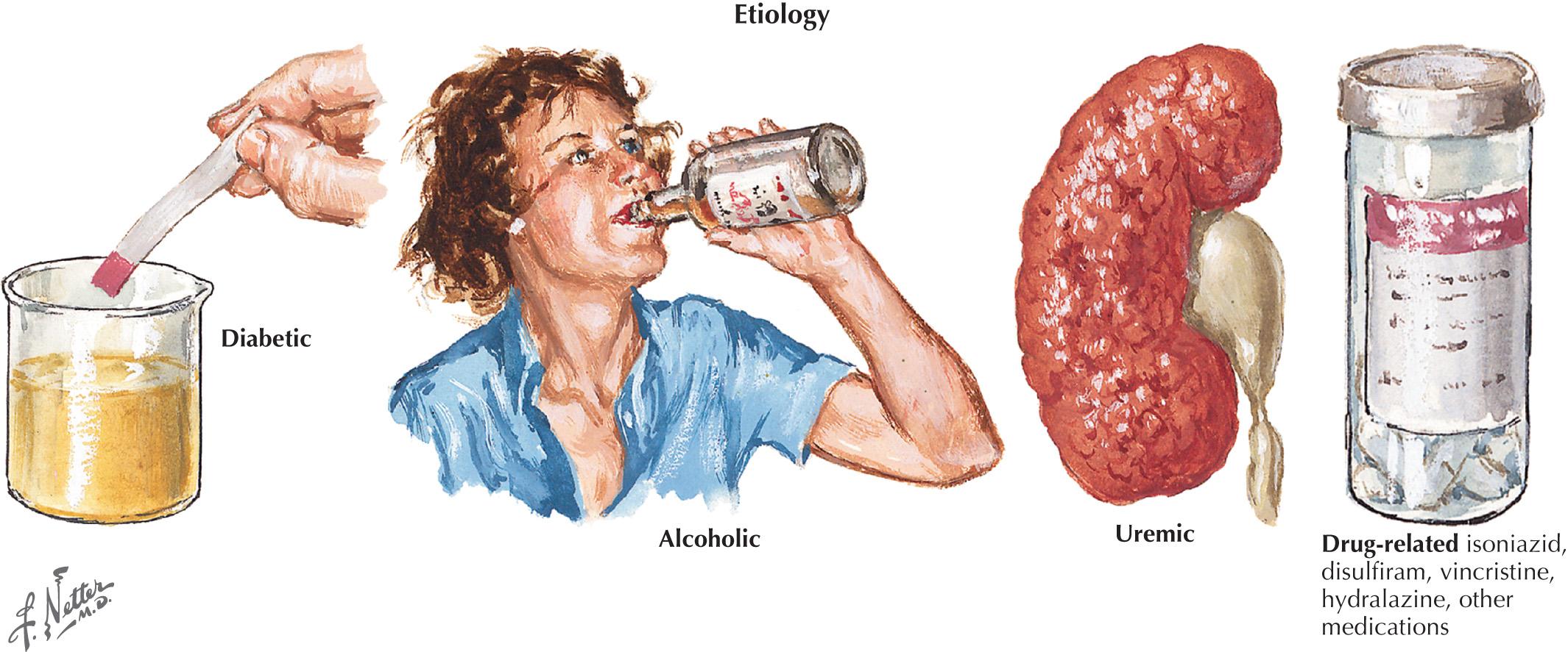 Fig. 67.2, Peripheral Neuropathies: Metabolic, Toxic, and Nutritional Etiology.