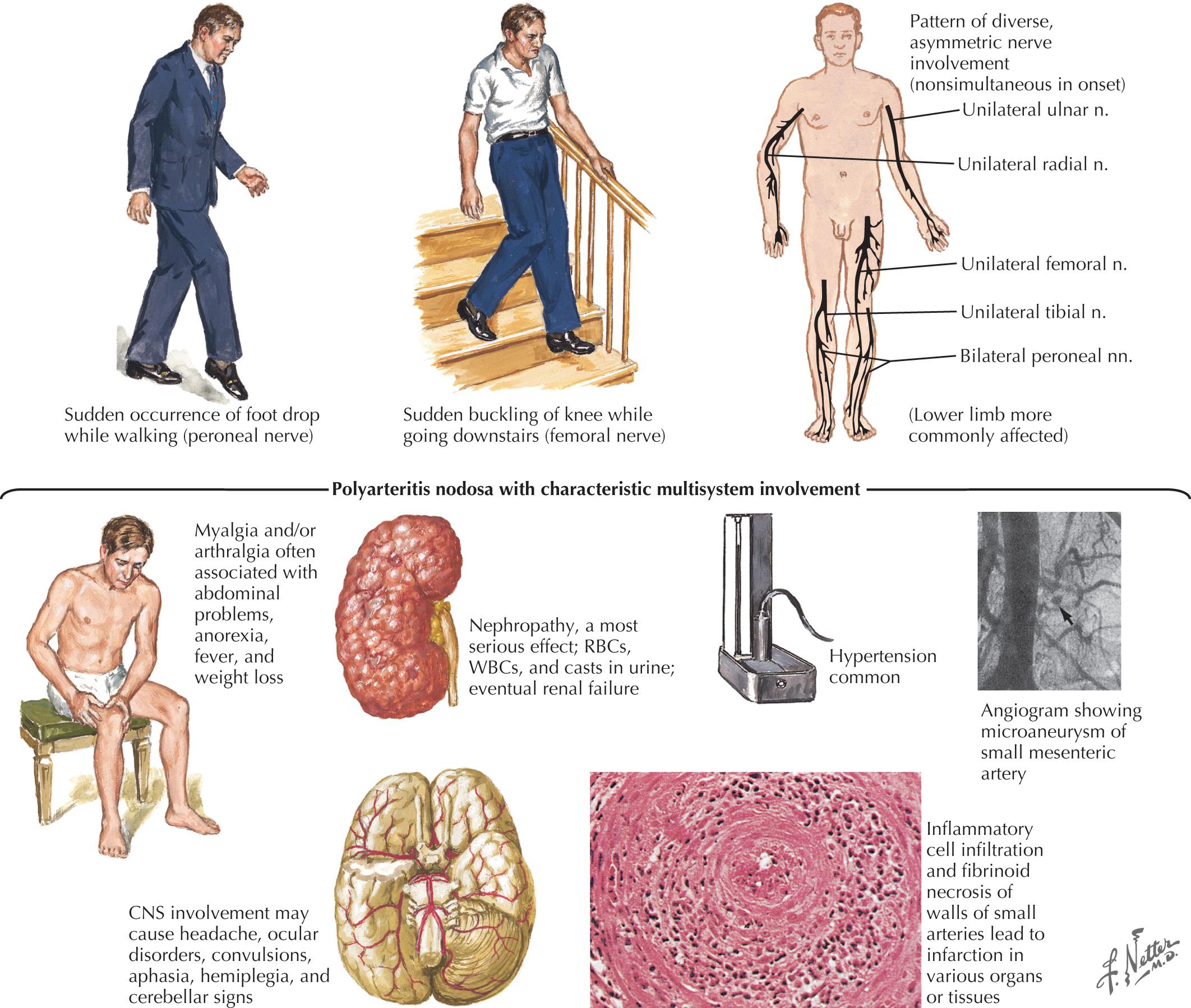 Fig. 67.3, Mononeuritis Multiplex Due to Systemic Vasculitis.