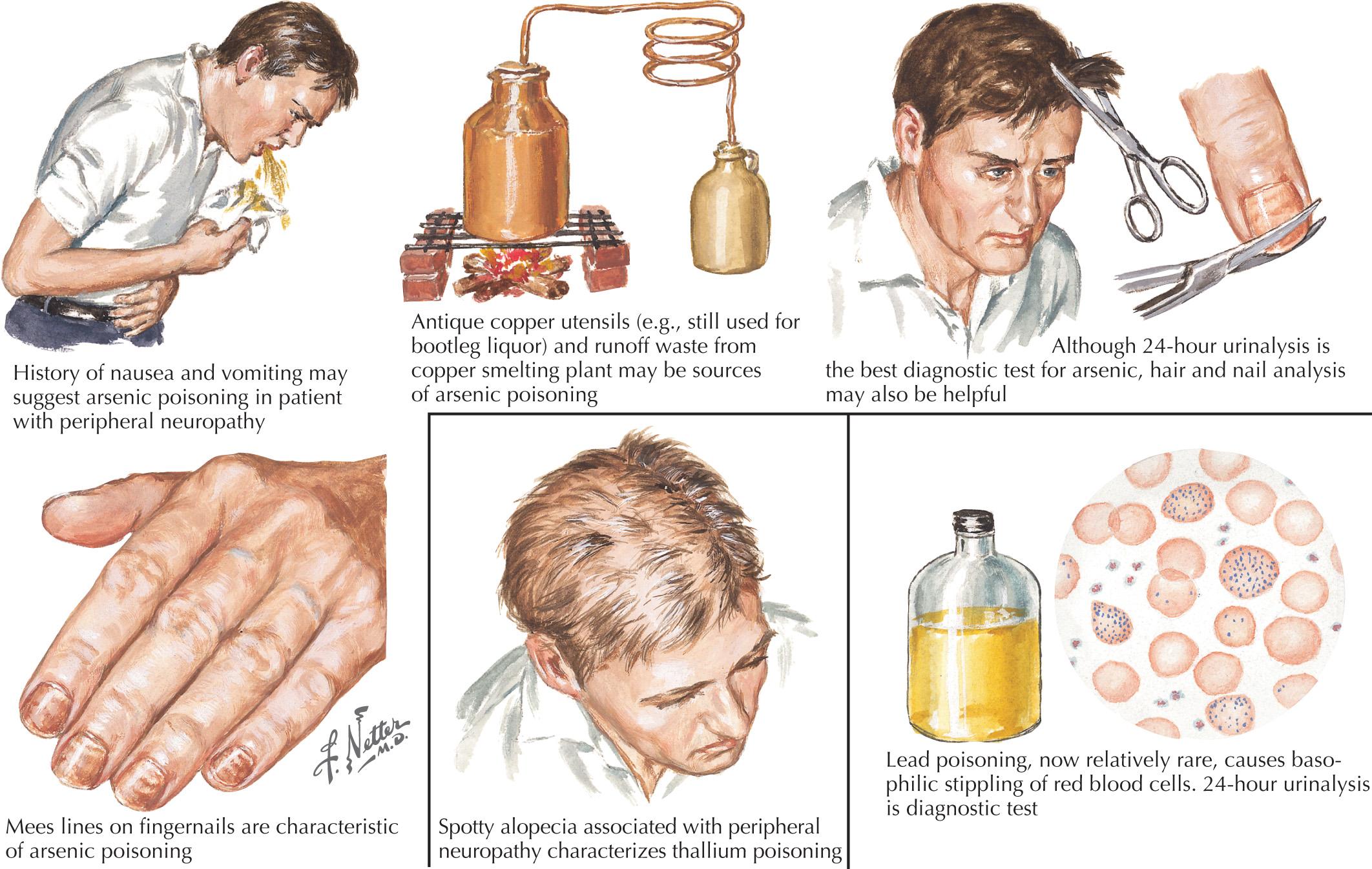 Fig. 67.4, Peripheral Neuropathy Caused by Heavy Metal Poisoning.