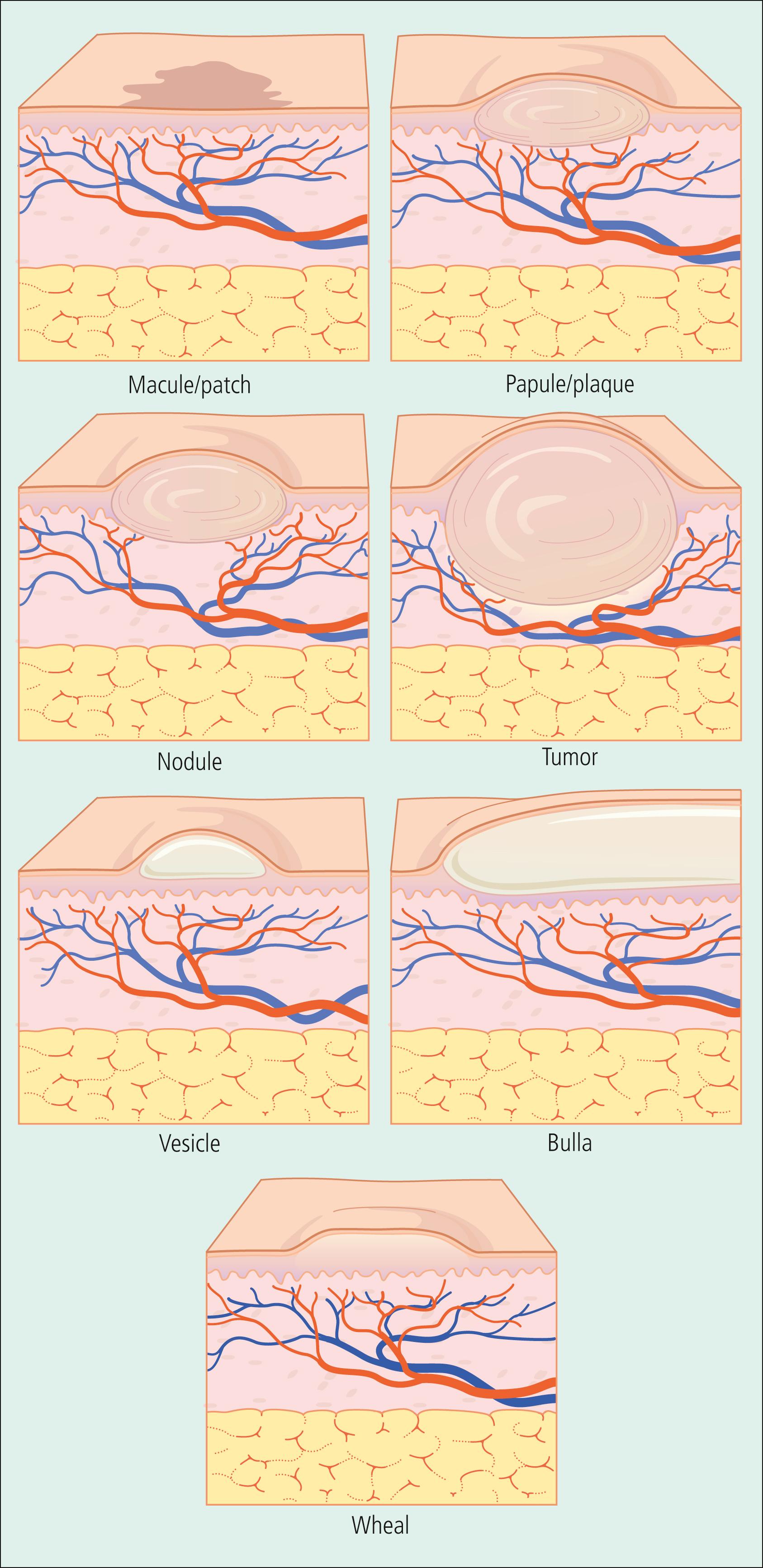 Fig. 61.1, Primary skin lesions.