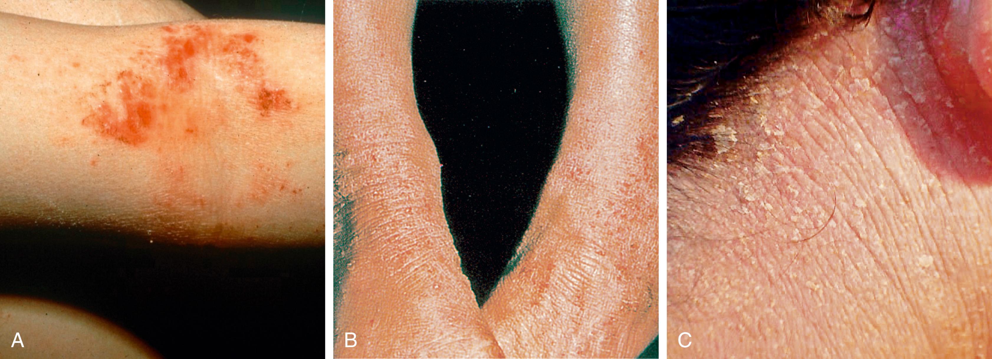 Fig. 61.12, Atopic dermatitis in childhood with lesions of the arm (A) , ankles (B) , and neck (C) .