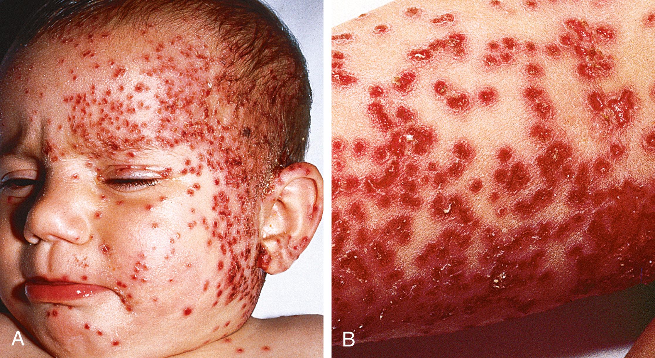 Fig. 61.13, Eczema herpeticum infection in a patient with atopic dermatitis. Numerous punched-out vesicles and erosions involving the face (A) and extremities (B) .