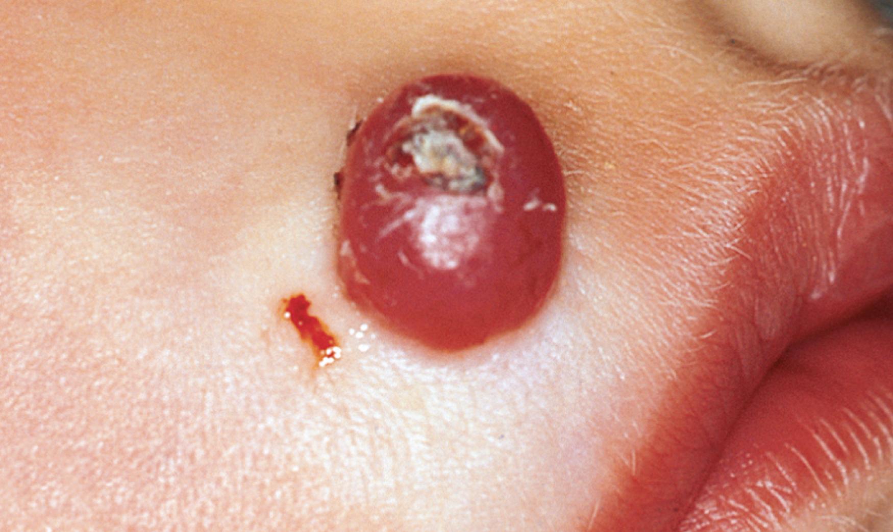 Fig. 61.14, Pyogenic granuloma. Hemorrhagic nodule with a central crust.