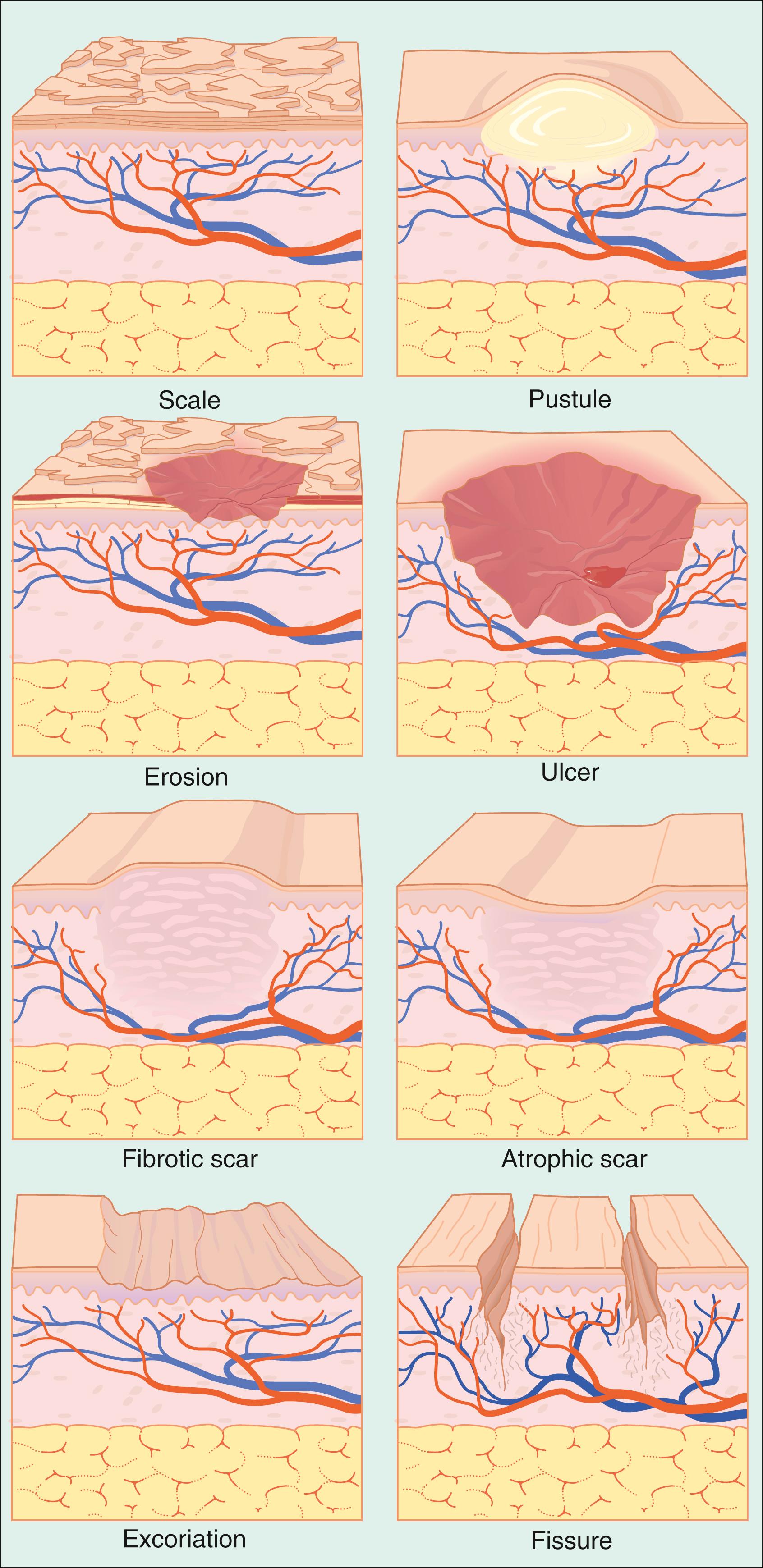 Fig. 61.2, Secondary skin lesions.