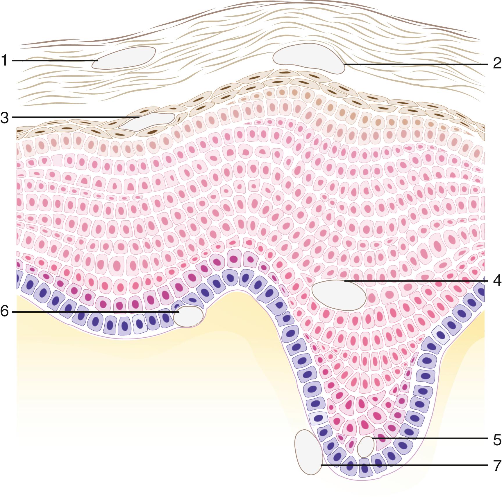 Fig. 61.3, Blister cleavage sites in the skin. 1, Intracorneal. 2, Subcorneal. 3, Granular layer. 4, Intraepidermal. 5, Suprabasal. 6, Junctional (between the basal cell membrane and basement membrane). 7, Subepidermal.