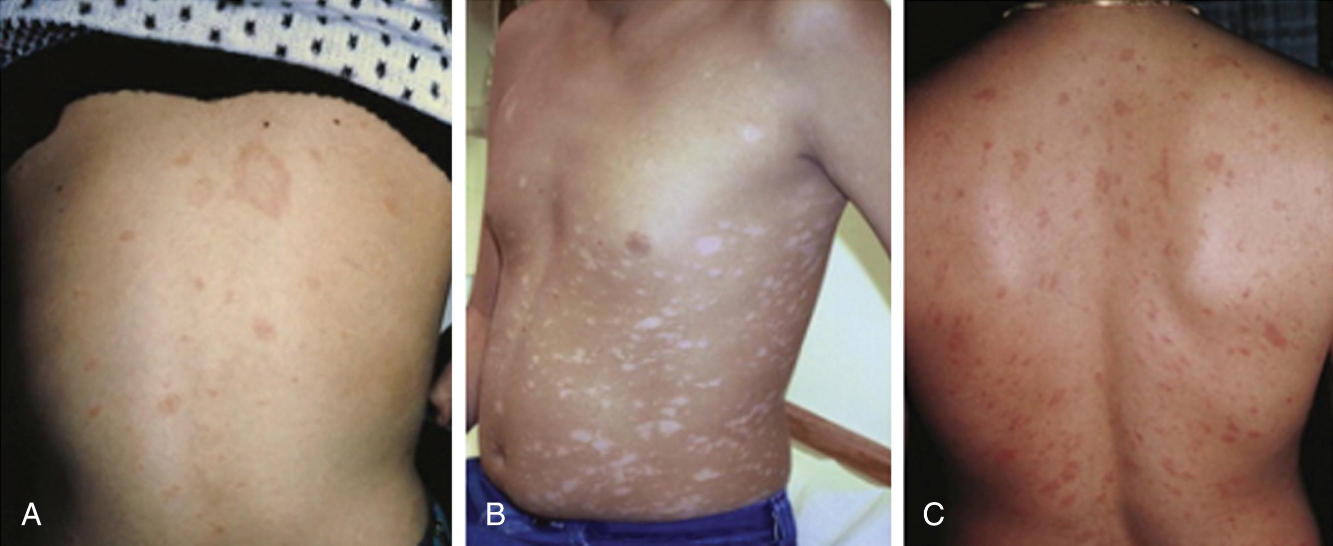 Fig. 61.4, Pityriasis rosea. A , The herald patch. B, Oval lesions oriented along the lines of skin cleavage on the trunk. C, Christmas tree distribution on the back.