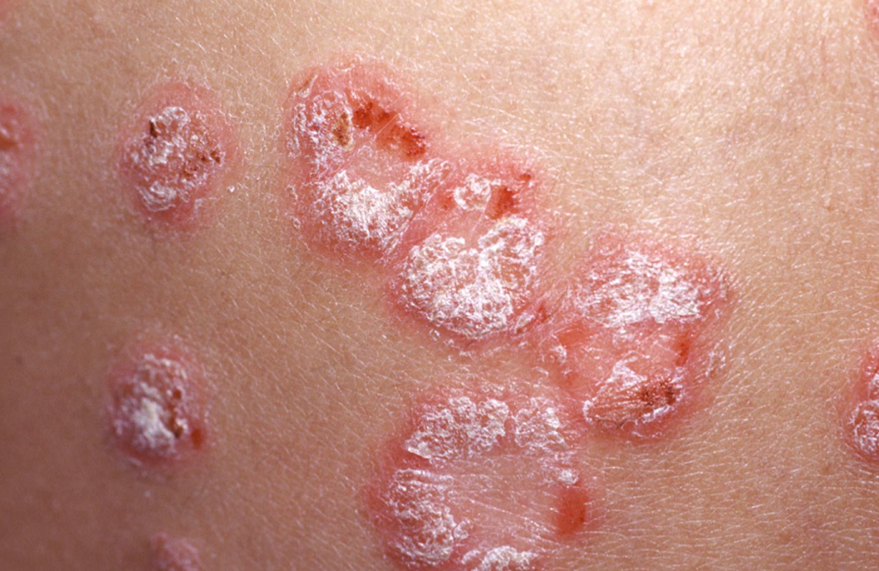 Fig. 61.5, Well-demarcated erythematous, scaly plaques of psoriasis.