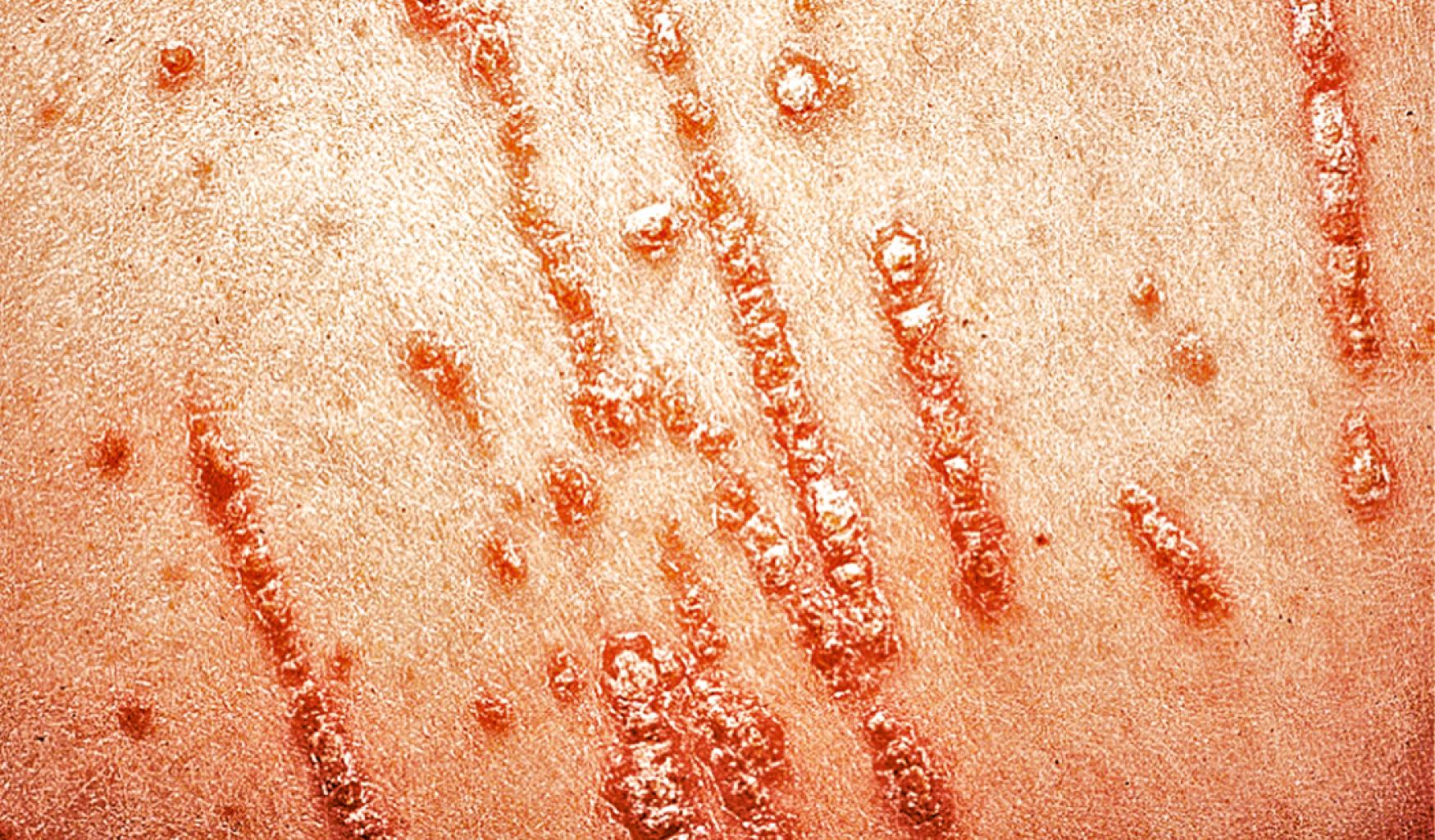 Fig. 61.6, Koebner phenomenon in psoriasis with linear plaques formed in the pattern of excoriations.