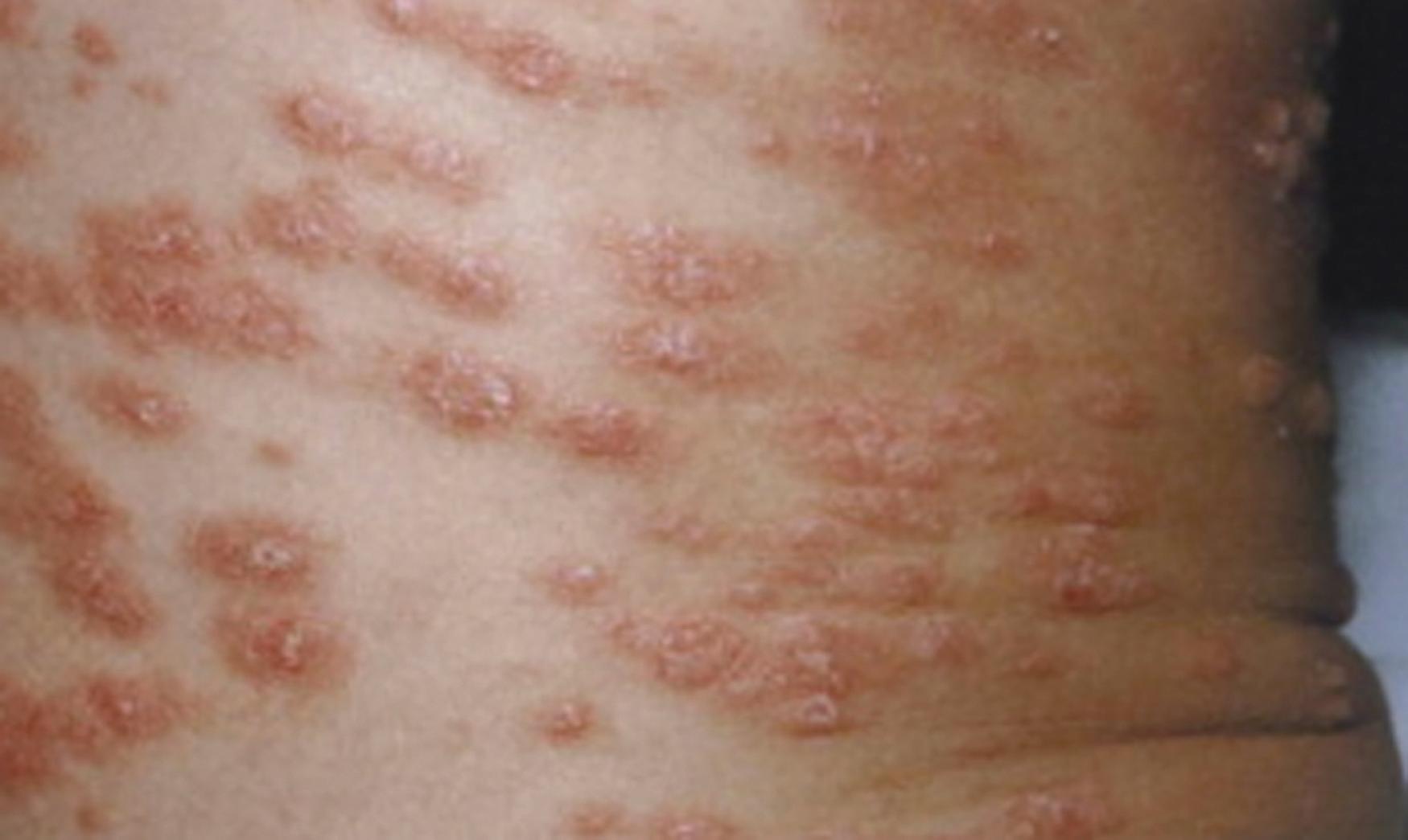 Fig. 61.7, Small droplike plaques of guttate psoriasis.