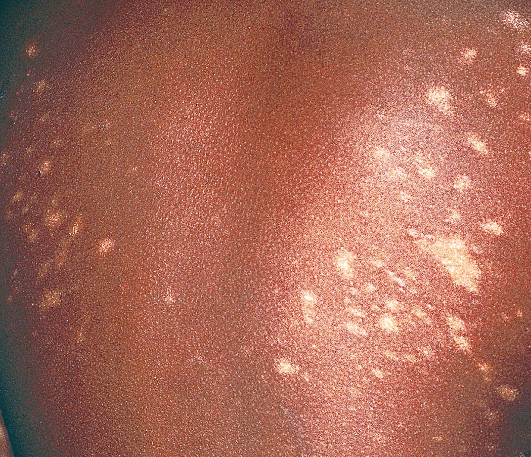 Fig. 61.8, Asymptomatic, hypopigmented, minimally scaly patches on the trunk of a child, which were present for several years and found to be cutaneous T-cell lymphoma.