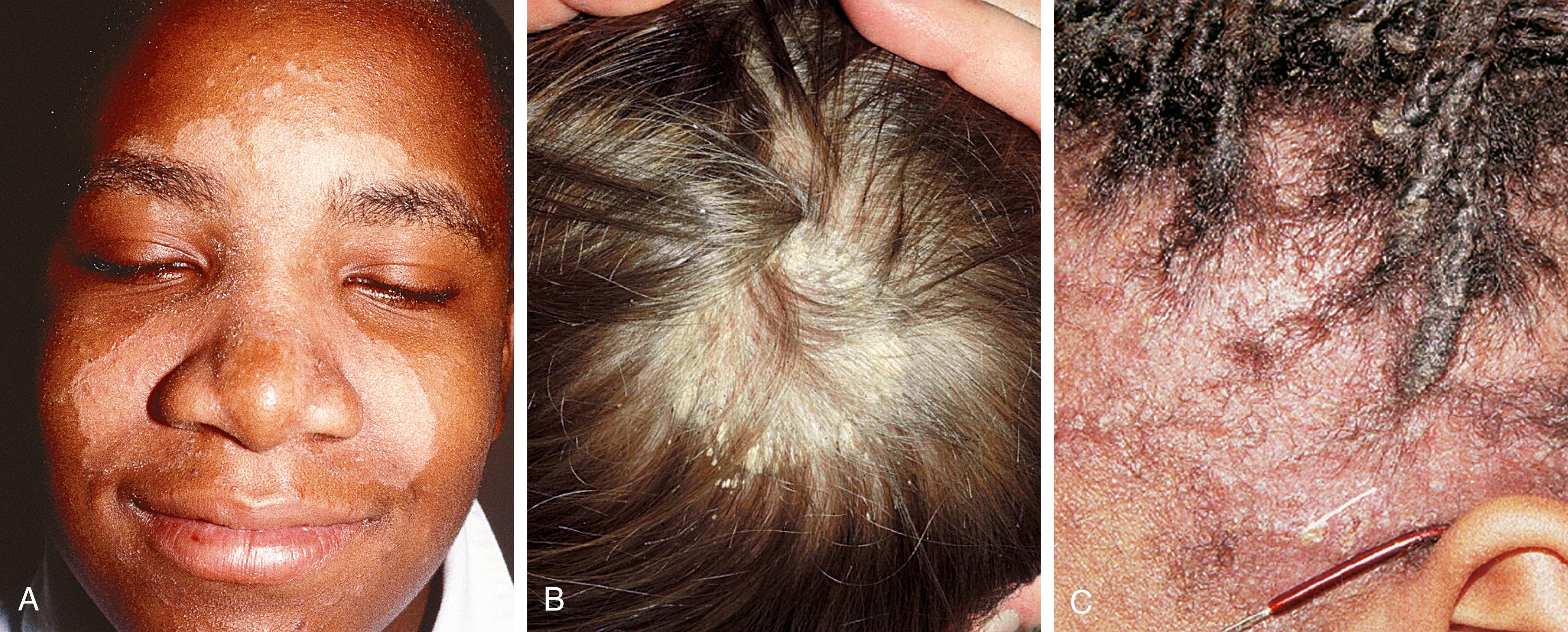 Fig. 61.9, Seborrheic dermatitis in the older child or adolescent. A, Scaly, hypopigmented lesions on the face involving eyebrows, nasolabial folds, and nasal bridge. B, Thick, yellow, adherent scale in the scalp. C, Confluent, scaly patches on the scalp with mild erythema.