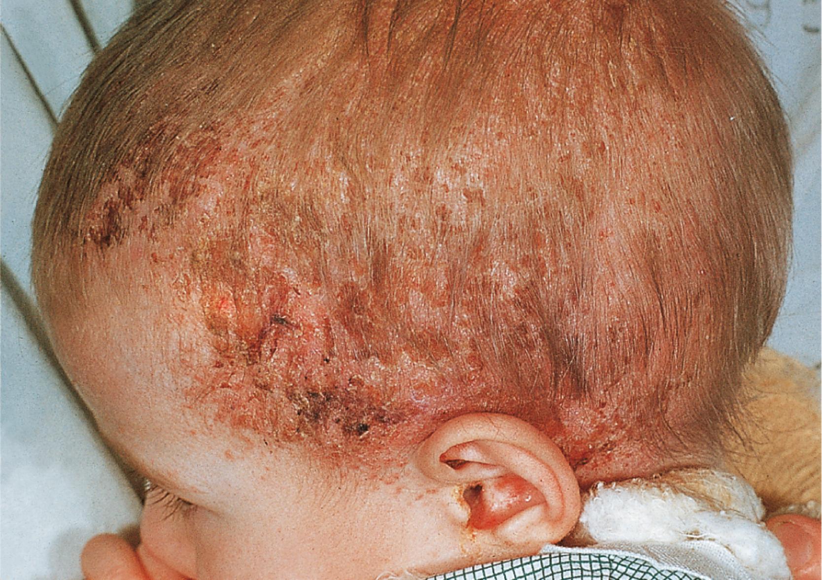 Fig. 61.10, Letterer-Siwe disease. Erythematous, slightly scaly plaques are present on the scalp of this child.