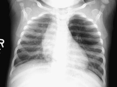 FIG. 5.1, Pulmonary hyperplasia. Chest radiograph shows hyperlucency and hyperexpansion of the left upper lobe.