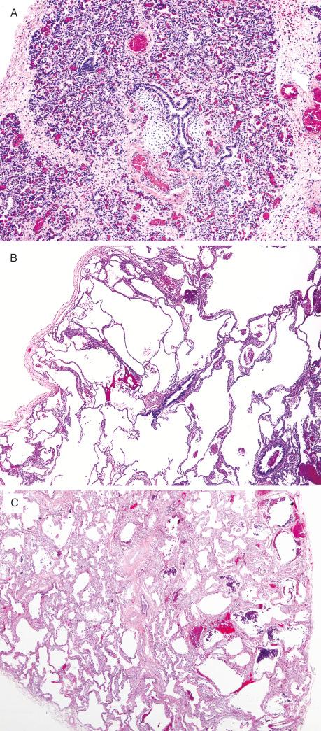 FIG. 5.2, Pulmonary hypoplasia. (A) There is a prominence of cartilaginous bronchi and interstitial thickening in the lung of a term infant with bilateral renal dysplasia. The surrounding airspaces show collapse and marked congestion. (B) The lung of an infant with oligohydramnios, biopsied at 2.5 months, has markedly enlarged and simplified airspaces; compare with the size of the bronchiole. (C) In Down syndrome, the lung shows airspace enlargement that is accentuated in the subpleural regions but is also evident throughout the lobule.