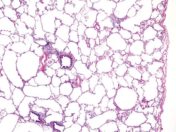 FIG. 5.3, Pulmonary hyperplasia. Numerous enlarged and simplified airspaces are seen in the lung parenchyma distal to a bronchial obstruction.