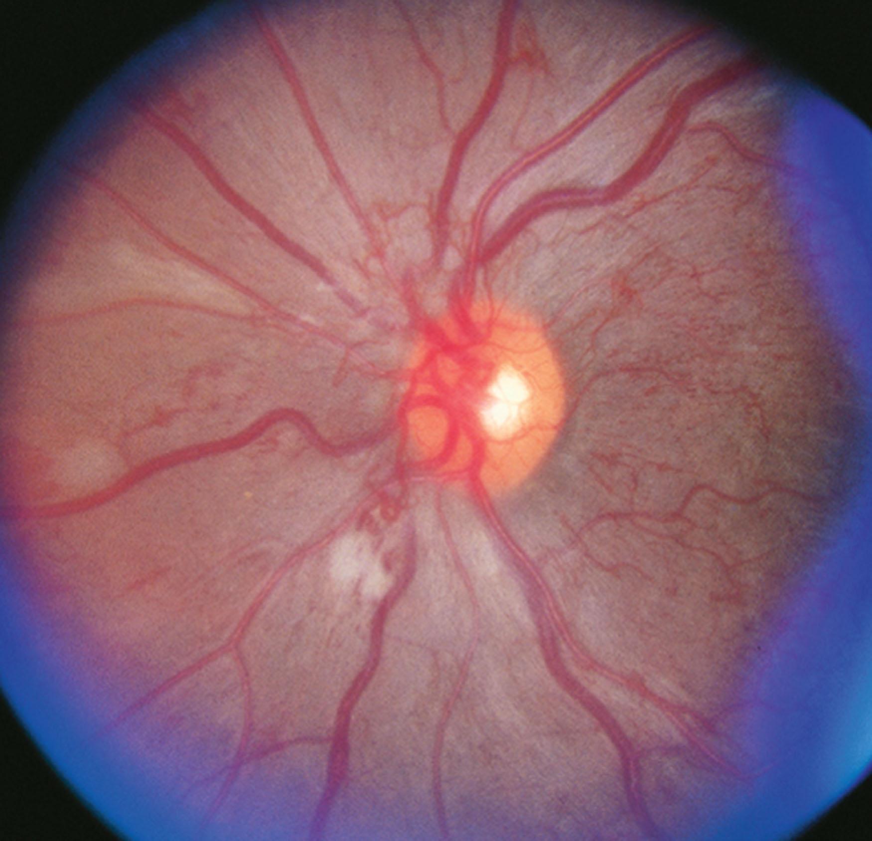 Fig. 50.1, Diabetic retinopathy. Proliferative diabetic retinopathy in a young adult. Neovascularization of the disc is present, in addition to multiple cotton-wool spots and intraretinal hemorrhages.