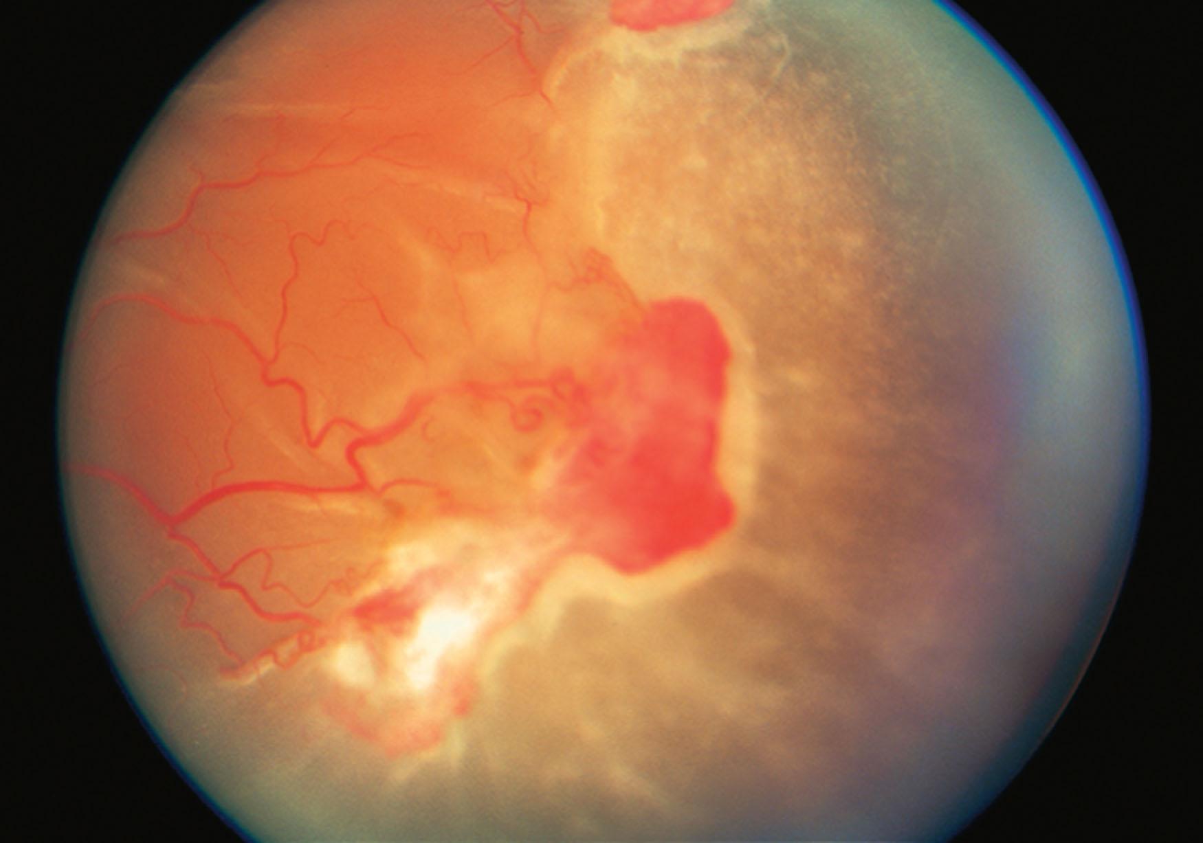 Fig. 50.2, Sickle cell (SC) retinopathy. Proliferative SC retinopathy in a young male with hemoglobin SC disease. The patient subsequently developed a tractional retinal detachment.