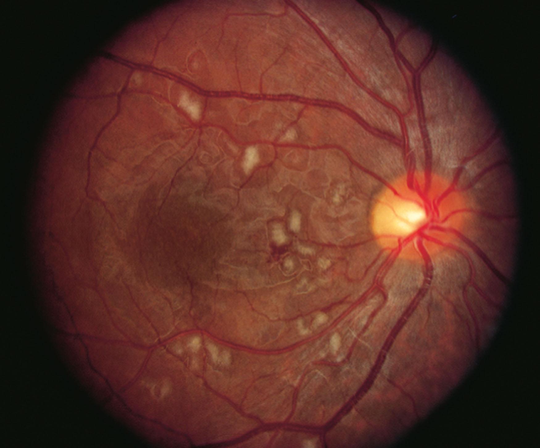 Fig. 50.3, Bone marrow transplant retinopathy. Multiple cotton-wool spots and a small perifoveal hemorrhage occurring 3 months after bone marrow transplant.