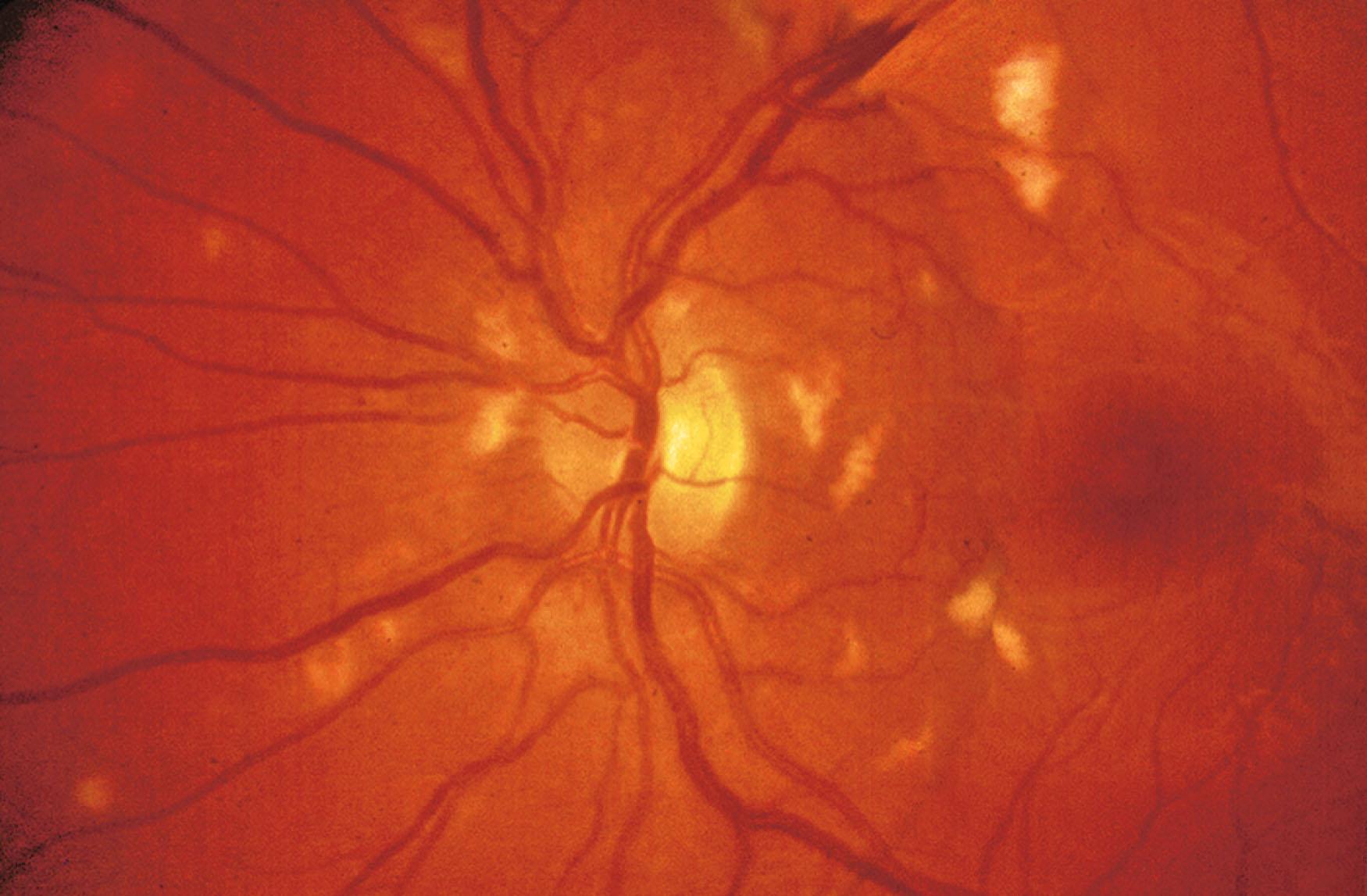 Fig. 50.4, Retinal vasculitis in a child with systemic lupus erythematosus. Multiple cotton-wool spots are evident.