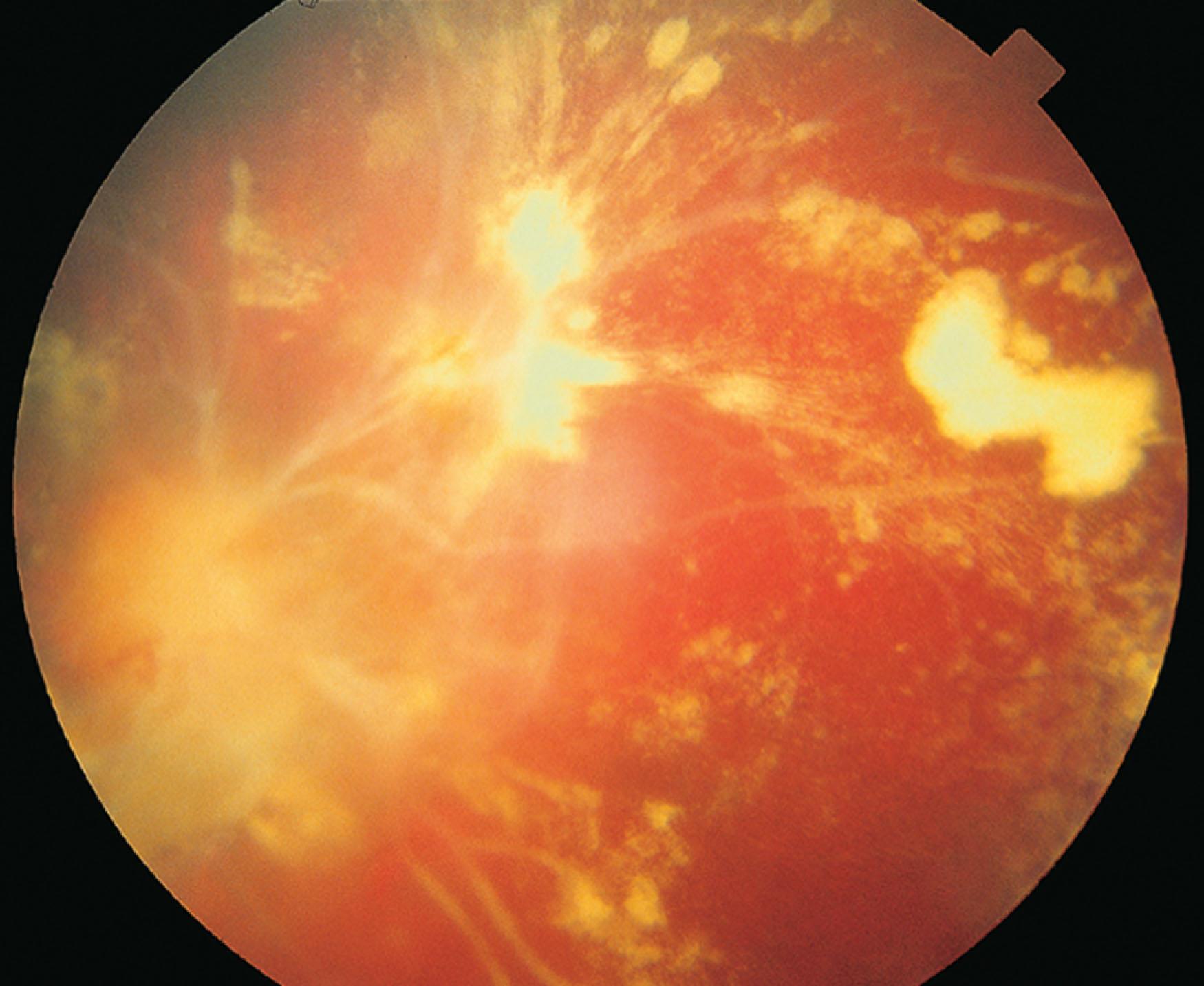 Fig. 50.5, Frosted branch angiitis. Unilateral frosted branch angiitis in a 10-year-old girl. No cause was established. There is retinal vessels sheathing and subretinal exudates.