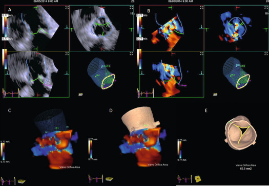 Figure 16.1, Example of automated aortic root modeling from 3-D TEE. A shows automated tracking from which the model is obtained with and without volume color Doppler. C and D show 2 displays of the model with color flow Doppler and E shows automated 3-D AV area measurement.
