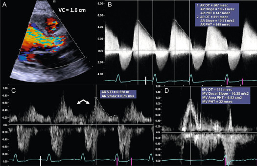 Figure 16.11, Elements of quantitative trans-thoracic echocardiography for AR. In (a) a wide jet of AR is seen with VC measuring 1.6 cm, in (b) dense spectral Doppler of AR is seen with a pressure-HT of ~ 140 ms, in (c) holo-diastolic flow reversal is seen with a VTI of ~ 23 cm, and a shortened mitral-inflow Doppler deceleration time of 111 ms is seen in (d).