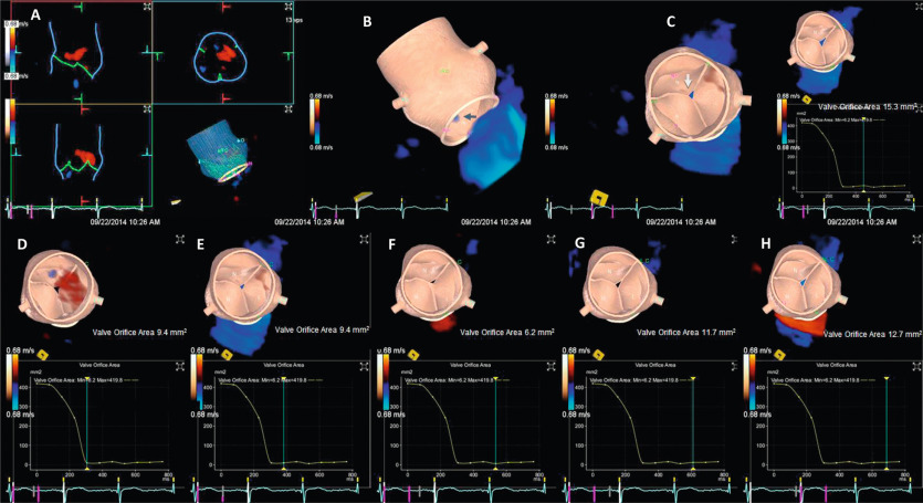 Figure 16.12, An example of anatomic 3-D AROA measured automated modeling of the aortic root by real-time volume color Doppler TEE. The landmarks of the aortic root can be automatically detected and tracked to model the aortic root (a), and mild AR (white arrow in b) can be seen, in (c) the largest 3-D AROA of 15 mm 2 is shown, and in (d–h) the variation in 3-D AROA throughout diastole is seen (9.4–12.7 mm 2 ).