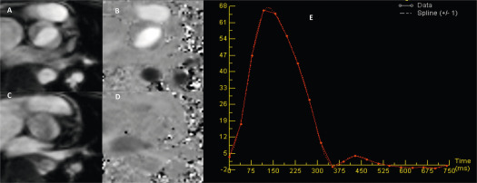 Figure 16.13, Quantification of flow using phase-contrast CMR. (a and b) Show magnitude and phase images of bicuspid aortic valve is systole, and (c and d) show the same in diastole. There is not phase-shift seen in diastole (no AR). The velocity–time curve in (e) shows no reversed flow (below baseline in diastole) and the AUC during systole yields aortic forward flow (stroke volume).