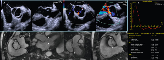 Figure 16.14, An example of eccentric AR in bicuspid aortic valve. (a) (in the blue box) From left to right shows 2-D TEE of the AV morphology and the eccentric AR by CFD. (b) Shows CMR from the patient, from left to right showing AV morphology in systole, two long-axis views showing two jets of AR (arrows), a short-axis of the AV and the two commissural jest of AR (arrows). In (c) quantification of AR is shown using phase-contrast velocity-encoded CMR. Total forward flow was 143.49 ml and the regurgitant volume (reverse flow below baseline in the curve) was 53.41 ml indicative of moderate AR. The regurgitant fraction is 37%.