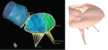 Figure 16.15, Mitral valve complex showing the mitral leaflets and the valve apparatus.