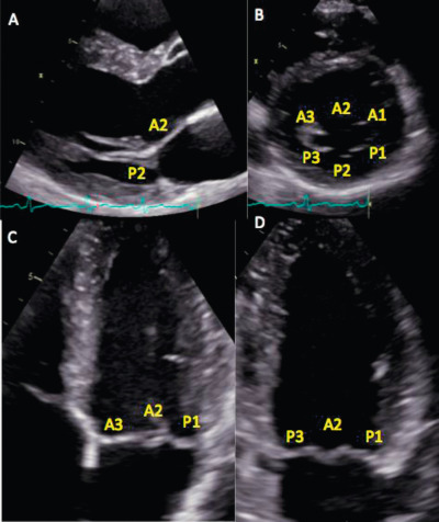 Figure 16.16, Mitral valve segmentation analysis with TTE.