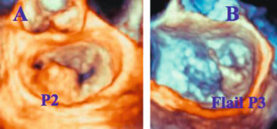 Figure 16.17, 3D volume rendering of the mitral valve. (a) P2 prolapse, (b) Flail of P3.