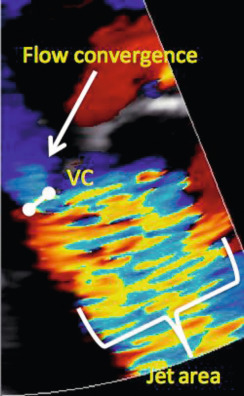 Figure 16.18, A semi-quantitative assessment of MR severity using the vena contracta width. The three components of the regurgitant jet (flow convergence zone, vena contracta, jet turbulence) are shown.