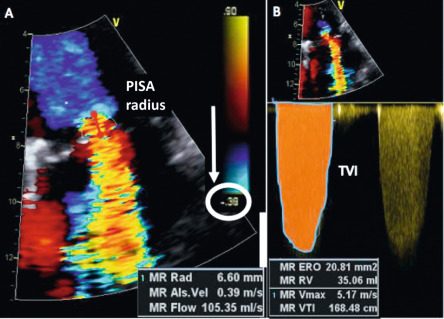 Figure 16.19, Quantitative assessment of MR severity using the PISA method. Stepwise analysis of MR: (a) Apical 4-chamber view, color-flow display, zoom of the selected zone, downward shift of zero baseline to obtain an hemispheric PISA; measurement of the PISA radius using the first aliasing; (b) Continuous wave Doppler of MR jet allowing calculation of the effective regurgitant orifice area (EROA) and regurgitant volume (RVol).