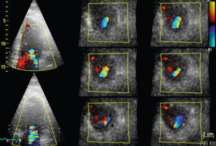 Figure 16.20, Vena contracta area as assessed by 3D echocardiography showing that the vena contracta of the regurgitant jet can be elliptic. 3D echocardiography allows correct alignment perpendicular to the jet direction and accurate measurement of the vena contracta area.