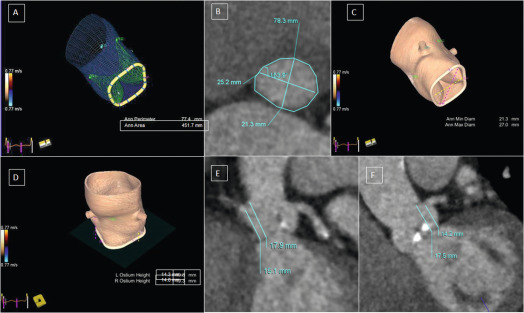 Figure 16.2, 3-D TEE and CT aortic annulus sizing for TAVR planning. The annulus perimeter/area, and minimum/maximum diameters (A and C) by automated 3-D TEE modeling and CT are similar. D shows coronary ostia-annulus distance by 3-D TEE and these are similar to CT measurements in E and F.