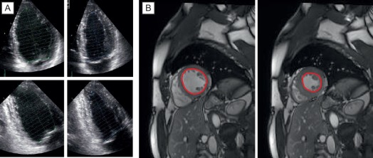 Figure 16.21, (a) The LV ejection fraction by 2D TTE was obtained by the modified Simpson's method in the apical 4- and 2-chamber view.(b) The LV ejection fraction by CMR was calculated by assessment of end-diastolic and end-systolic LV volumes in multiple parallel short-axis slices.